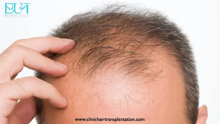 اشتباهات رایج در زمان کاشت مو چیست